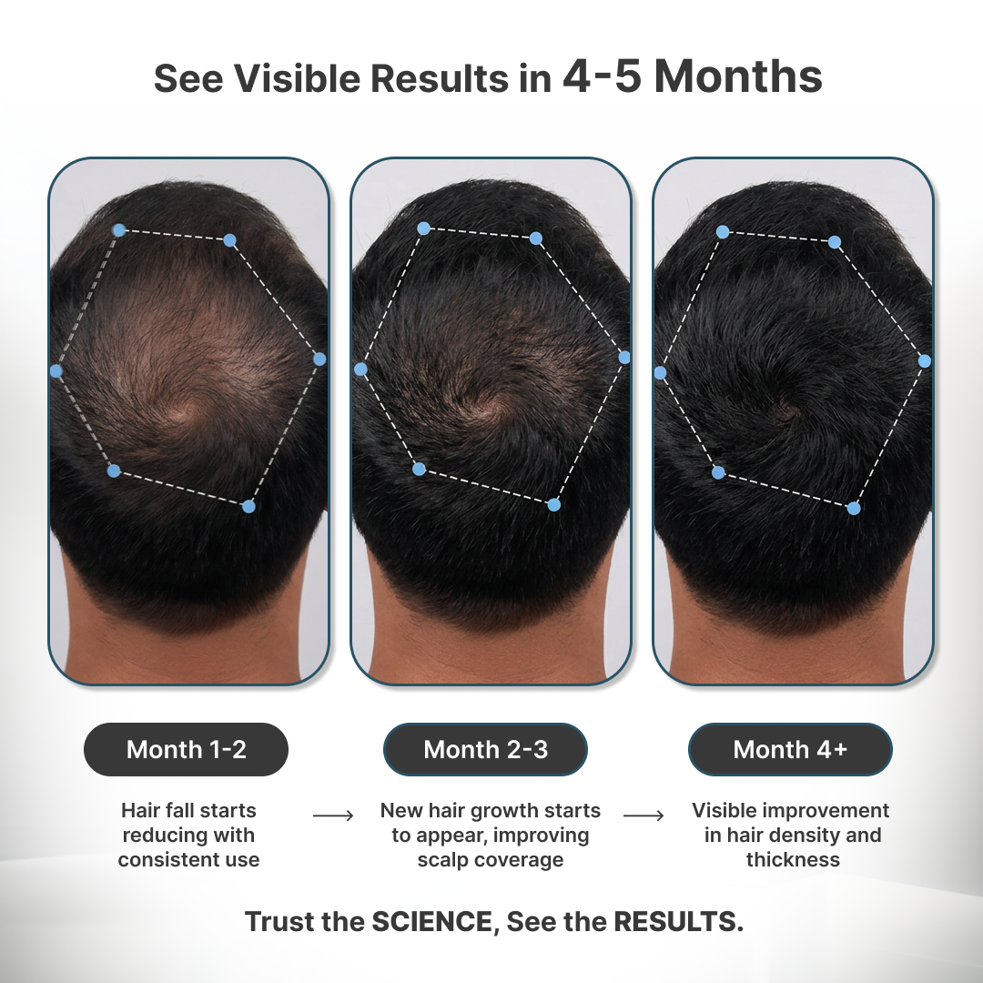 Telogen Effluvium Kit + Minoxidil 5% + 0.1% Finasteride + Biwash shampoo