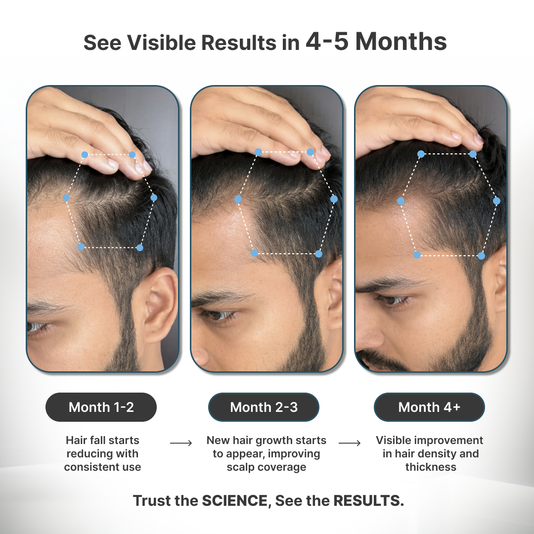 Telogen Effluvium Kit + Minoxidil 2% + Biwash shampoo